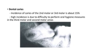 • Dental caries
- Incidence of caries of the 2nd molar or 3rd molar is about 15%
- high incidence is due to difficulty to perform oral hygiene measures
in the third molar and second molar areas
 