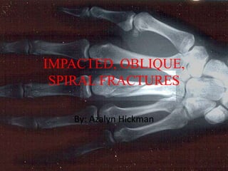 IMPACTED, OBLIQUE,
 SPIRAL FRACTURES

   By: Azalyn Hickman
 