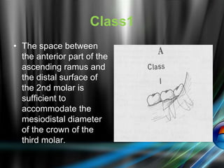 Class1
• The space between
the anterior part of the
ascending ramus and
the distal surface of
the 2nd molar is
sufficient to
accommodate the
mesiodistal diameter
of the crown of the
third molar.
 