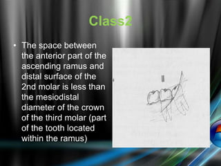 Class2
• The space between
the anterior part of the
ascending ramus and
distal surface of the
2nd molar is less than
the mesiodistal
diameter of the crown
of the third molar (part
of the tooth located
within the ramus)
 