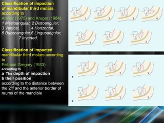 Classification of impaction
of mandibular third molars,
according to
Archer (1975) and Kruger (1984).
1 Mesioangular, 2 Distoangular,
3 Vertical, 4 Horizontal,
5 Buccoangular,6 Linguoangular,
7 inverted.
Classification of impacted
mandibular third molars according
to
Pell and Gregory (1933):
according to
a The depth of impaction
b their position
according to the distance between
the 2nd and the anterior border of
raums of the mandible
 