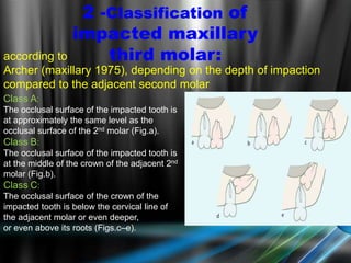 2 -Classification of
impacted maxillary
third molar:according to
Archer (maxillary 1975), depending on the depth of impaction
compared to the adjacent second molar
Class A:
The occlusal surface of the impacted tooth is
at approximately the same level as the
occlusal surface of the 2nd molar (Fig.a).
Class B:
The occlusal surface of the impacted tooth is
at the middle of the crown of the adjacent 2nd
molar (Fig.b).
Class C:
The occlusal surface of the crown of the
impacted tooth is below the cervical line of
the adjacent molar or even deeper,
or even above its roots (Figs.c–e).
 