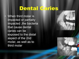 • When third molar is
impacted or partially
impacted ,the bacteria
that cause dental
caries can be
exposed to the distal
aspect of the 2nd
molar, as well as to
third molar
Dental Caries
 