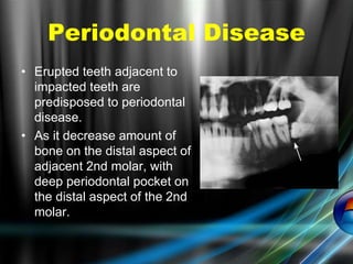 • Erupted teeth adjacent to
impacted teeth are
predisposed to periodontal
disease.
• As it decrease amount of
bone on the distal aspect of
adjacent 2nd molar, with
deep periodontal pocket on
the distal aspect of the 2nd
molar.
Periodontal Disease
 