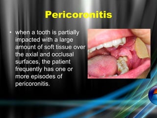 Pericoronitis
• when a tooth is partially
impacted with a large
amount of soft tissue over
the axial and occlusal
surfaces, the patient
frequently has one or
more episodes of
pericoronitis.
 
