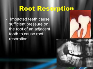 • Impacted teeth cause
sufficient pressure on
the root of an adjacent
tooth to cause root
resorption.
Root Resorption
 