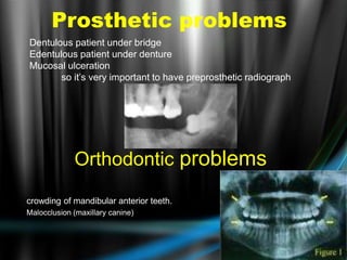 Orthodontic problems
crowding of mandibular anterior teeth.
Malocclusion (maxillary canine)
Prosthetic problems
Dentulous patient under bridge
Edentulous patient under denture
Mucosal ulceration
so it’s very important to have preprosthetic radiograph
 