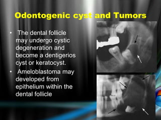 Odontogenic cyst and Tumors
• The dental follicle
may undergo cystic
degeneration and
become a dentigerios
cyst or keratocyst.
• Ameloblastoma may
developed from
epithelium within the
dental follicle
 