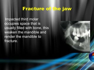 Fracture of the jaw
Impacted third molar
occupies space that is
usually filled with bone, this
weaken the mandible and
render the mandible to
fracture.
 