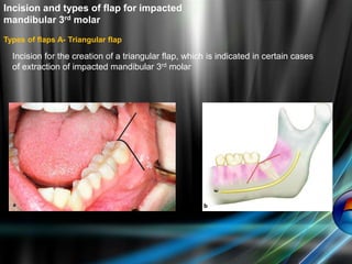 Incision and types of flap for impacted
mandibular 3rd molar
Types of flaps A- Triangular flap
Incision for the creation of a triangular flap, which is indicated in certain cases
of extraction of impacted mandibular 3rd molar
 