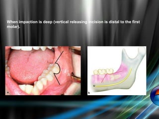 When impaction is deep (vertical releasing incision is distal to the first
molar).
 