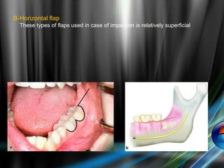 B-Horizontal flap
These types of flaps used in case of impaction is relatively superficial
 