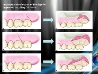 Incision and reflection of the flap for
impacted maxillary 3rd molar
 