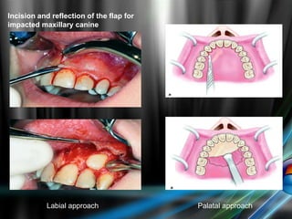 Incision and reflection of the flap for
impacted maxillary canine
Palatal approachLabial approach
 