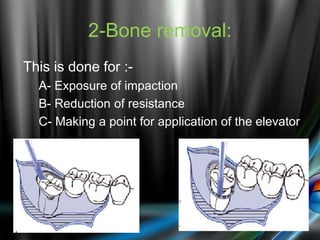 2-Bone removal:
This is done for :-
A- Exposure of impaction
B- Reduction of resistance
C- Making a point for application of the elevator
 