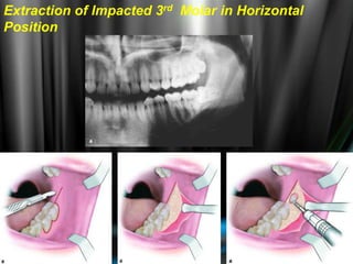 Extraction of Impacted 3rd Molar in Horizontal
Position
 