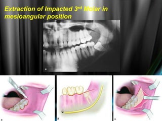 Extraction of Impacted 3rd Molar in
mesioangular position
 