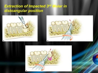 Extraction of Impacted 3rd Molar in
distoangular position
 