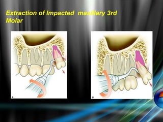 Extraction of Impacted maxillary 3rd
Molar
 