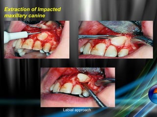 Extraction of Impacted
maxillary canine
Labial approach
 