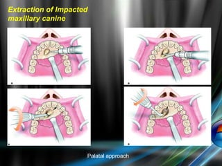 Extraction of Impacted
maxillary canine
Palatal approach
 