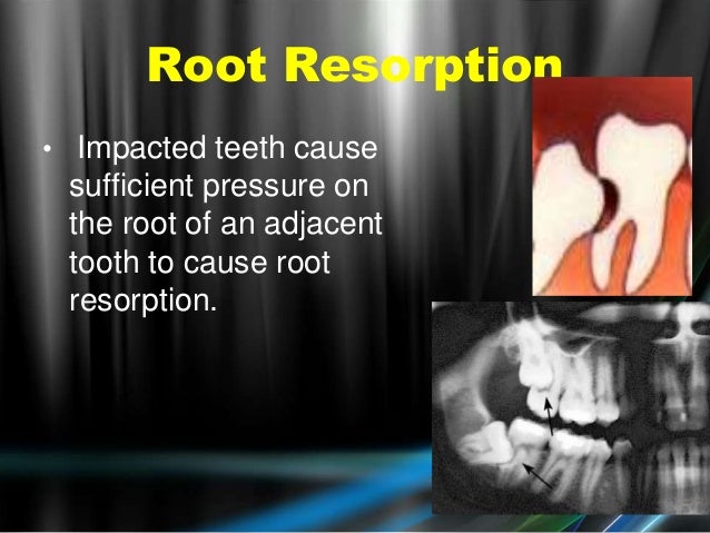 Impacted teeth  by Dr.Basma Elbeshlawy