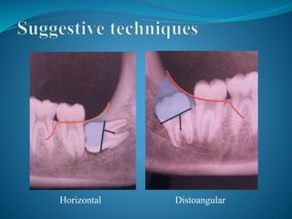 Impacted teeth | PPTX