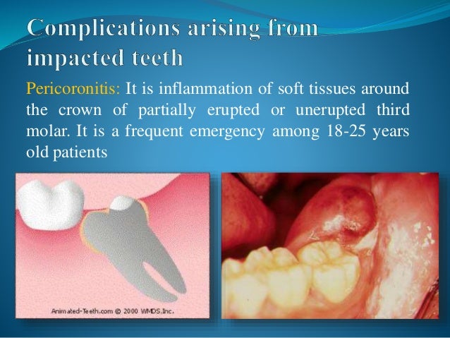 impacted tooth barca fontanacountryinn com impacted tooth