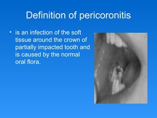 Definition of pericoronitis
• is an infection of the soft
tissue around the crown of
partially impacted tooth and
is caused by the normal
oral flora.
 
