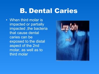 • When third molar is
impacted or partially
impacted ,the bacteria
that cause dental
caries can be
exposed to the distal
aspect of the 2nd
molar, as well as to
third molar
B. Dental Caries
 