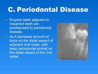 • Erupted teeth adjacent to
impacted teeth are
predisposed to periodontal
disease.
• As it decrease amount of
bone on the distal aspect of
adjacent 2nd molar, with
deep periodontal pocket on
the distal aspect of the 2nd
molar.
C. Periodontal Disease
 