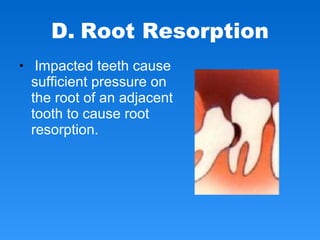 • Impacted teeth cause
sufficient pressure on
the root of an adjacent
tooth to cause root
resorption.
D. Root Resorption
 