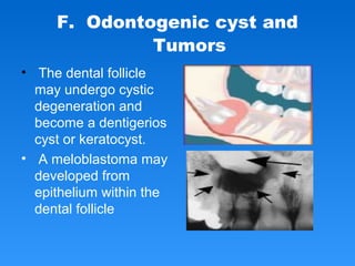 F. Odontogenic cyst and
Tumors
• The dental follicle
may undergo cystic
degeneration and
become a dentigerios
cyst or keratocyst.
• A meloblastoma may
developed from
epithelium within the
dental follicle
 