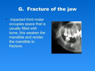 G. Fracture of the jaw
• impacted third molar
occupies space that is
usually filled with
bone, this weaken the
mandible and render
the mandible to
fracture.
 