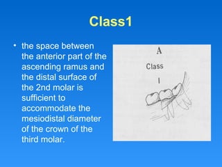 Class1
• the space between
the anterior part of the
ascending ramus and
the distal surface of
the 2nd molar is
sufficient to
accommodate the
mesiodistal diameter
of the crown of the
third molar.
 