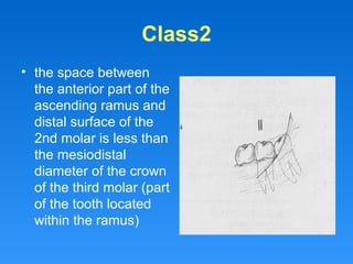 Class2
• the space between
the anterior part of the
ascending ramus and
distal surface of the
2nd molar is less than
the mesiodistal
diameter of the crown
of the third molar (part
of the tooth located
within the ramus)
 