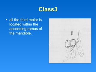 Class3
• all the third molar is
located within the
ascending ramus of
the mandible.
 