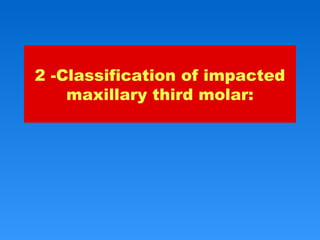 2 -Classification of impacted
maxillary third molar:
 