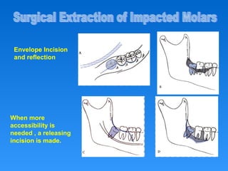 Envelope Incision
and reflection
When more
accessibility is
needed , a releasing
incision is made.
 