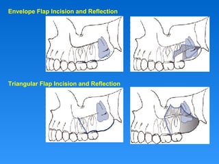 Envelope Flap Incision and Reflection
Triangular Flap Incision and Reflection
 