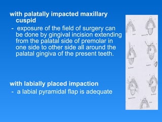 with palatally impacted maxillary
cuspid
- exposure of the field of surgery can
be done by gingival incision extending
from the palatal side of premolar in
one side to other side all around the
palatal gingiva of the present teeth.
with labially placed impaction
- a labial pyramidal flap is adequate
 
