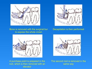 Bone is removed with the surgical bur
to expose the whole crown
Decapitation is then performed
A purchase point is prepared in the
root, which is then removed with an
elevator
The second root is removed in the
same way
 