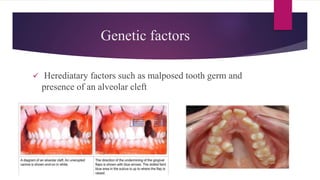 Impacted teeth / Dr.sarah alkhateeb | PPTX