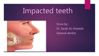 Impacted teeth
Done by:-
Dr .Sarah AL-khateeb
General dentist
 