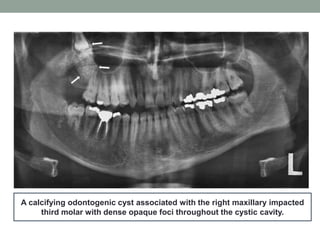 A calcifying odontogenic cyst associated with the right maxillary impacted
third molar with dense opaque foci throughout the cystic cavity.
 