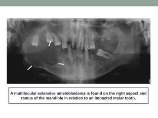 A multilocular extensive ameloblastoma is found on the right aspect and
ramus of the mandible in relation to an impacted molar tooth.
 