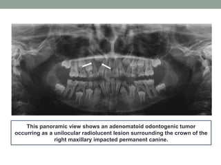 This panoramic view shows an adenomatoid odontogenic tumor
occurring as a unilocular radiolucent lesion surrounding the crown of the
right maxillary impacted permanent canine.
 