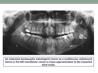 An extensive keratocystic odontogenic tumor as a multilocular radiolucent
lesion in the left mandibular ramus in close approximation to the impacted
third molar.
 