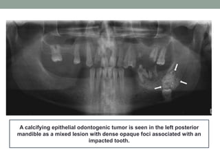 A calcifying epithelial odontogenic tumor is seen in the left posterior
mandible as a mixed lesion with dense opaque foci associated with an
impacted tooth.
 