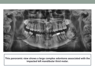 This panoramic view shows a large complex odontoma associated with the
impacted left mandibular third molar.
 